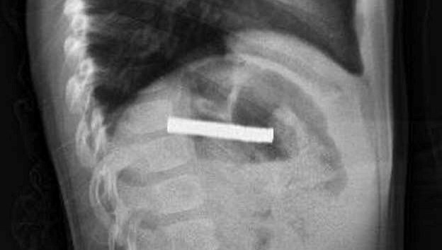 bogazindan 19 adet miknatis cikartildi khFBqF5j