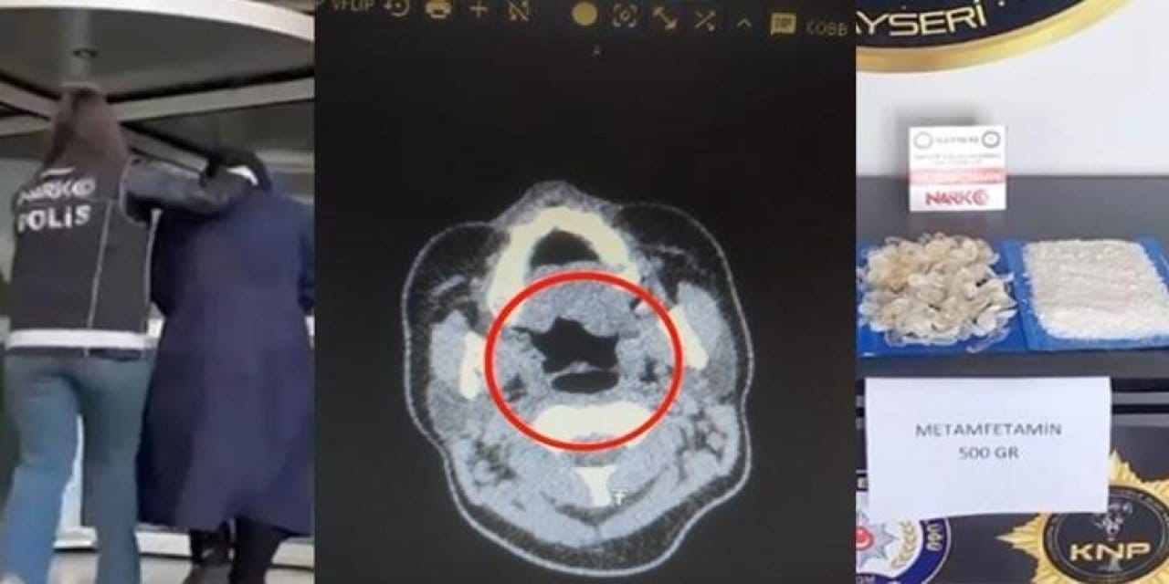 doktorlar bile inanamadi midesinden tam 500 gram metamfetamin cikti xuRfCwYX.jpg